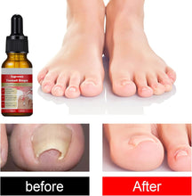 Ingrown Toenail Treatment Drop- Ingrown Toenail Treatment- Cuticle Care Oils for Ingrown Toenails - Trimming Toenail Softening Drops Natural Ingrown Toenail Correction Fungal Nail - 10ml (1Pcs)