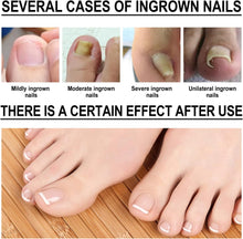 Ingrown Toenail Treatment Drop- Ingrown Toenail Treatment- Cuticle Care Oils for Ingrown Toenails - Trimming Toenail Softening Drops Natural Ingrown Toenail Correction Fungal Nail - 10ml (1Pcs)