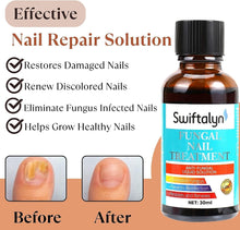 Fungal Nail Treatment:Fungal Nail Treatment for Toenails Extra Strong-Nail Fungus Treatment for Toenail-Nail Fungal Treatment-30ML