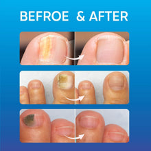 Fungal Nail Treatment, Fungus Nail Cream, Strong Anti-Fungal Toenail Cream, Nail Repair Nourishing Treatment, Restores Discolored and Damaged Nails