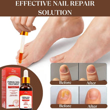 Fungal Nail Treatment: Nail Fungus Treatment for Toenail - Fungal Nail Treatment for Toenails Extra Strong - Toe Nail Fungal Treatment - Safely and Gently Reclaim Healthy Nails - 30ml