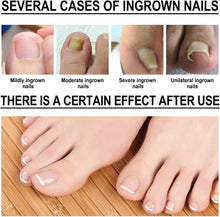 Ingrowth Toenail Correction Treatment Oil, Ingrown Toenail Treatment Kit, Correction Ingrown Toenail Drops, Cuticle Nail Oil Nail Fungal Treatment for Ingrown Toenail, with Glass Nail File