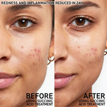 The INKEY List Succinic Acid Blemish Treatment 15ml