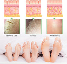 Urea 42% Foot Cream,Foot Cream For Cracked Heels And Dry Skin,Foot Moisturiser,Foot Care cream,Deep Hydrating & Smooth Dull Skin,Hard Skin Remover Foot Cream,Athlete Foot Cream-Hand & Foot Care-100g